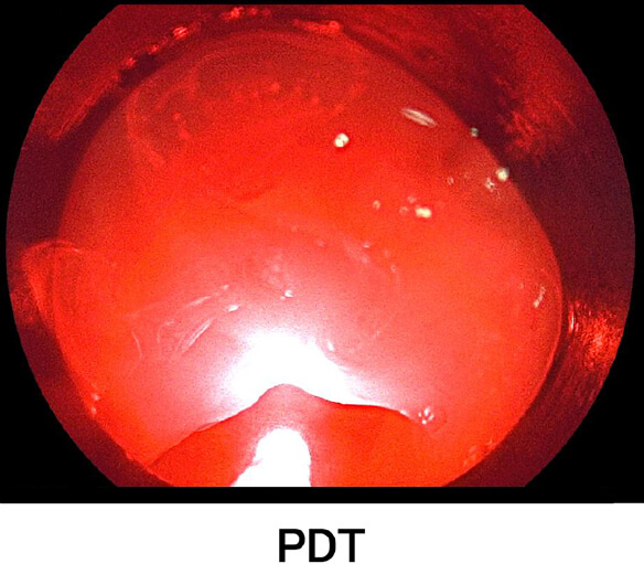 PDT