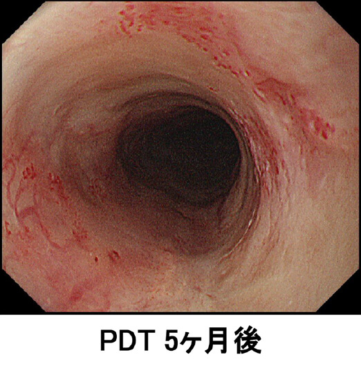 PDT 5ヶ月後